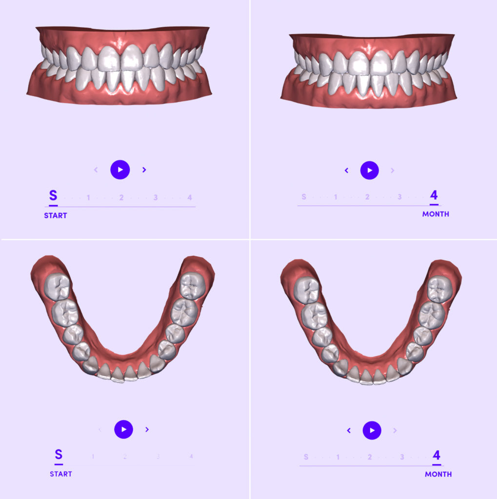 is smile direct club good for your teeth